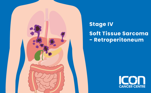 Stage IV soft tissue sarcoma in retroperitoneum illustration