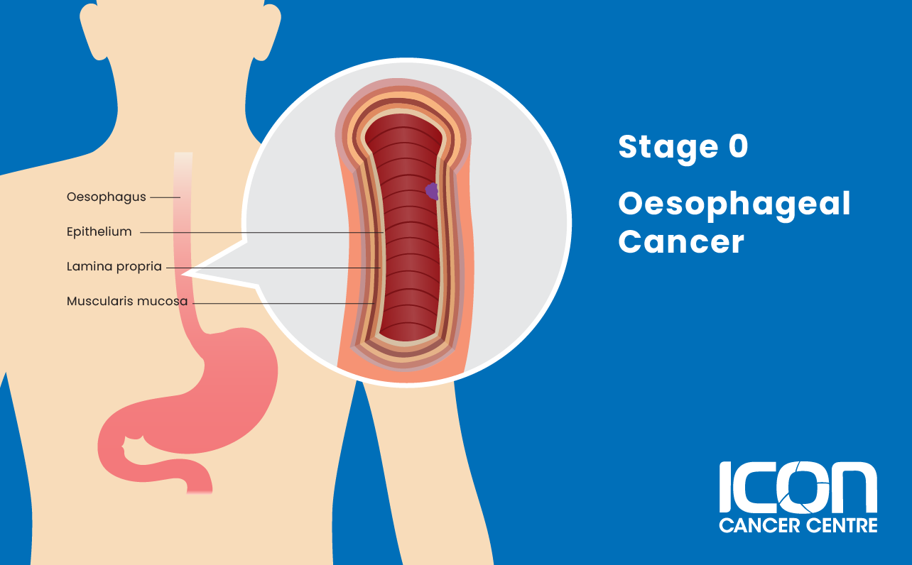 Stage 0 oesophageal cancer illustration