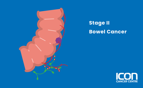 Illustration of Bowel Cancer Stage 2