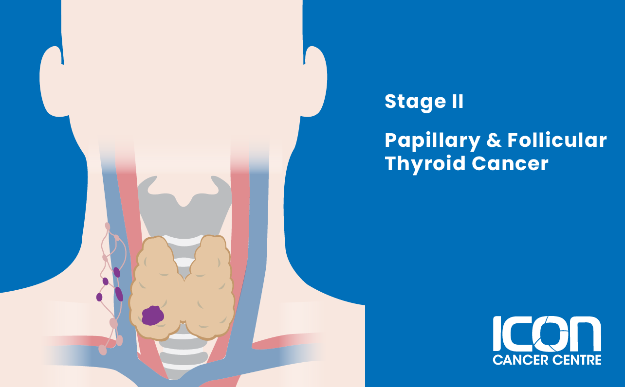 Stage II papillary and follicular thyroid cancer illustration