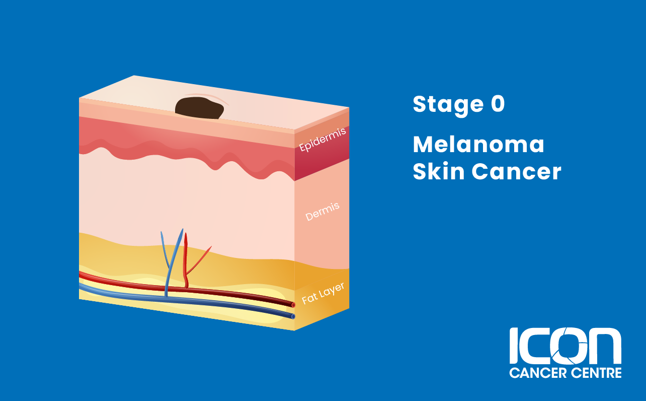 Stage 0 melanoma illustration