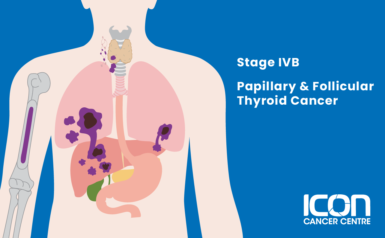 Stage IVB papillary and follicular thyroid cancer illustration