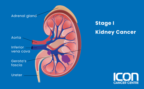 Stage 1 kidney cancer illustration
