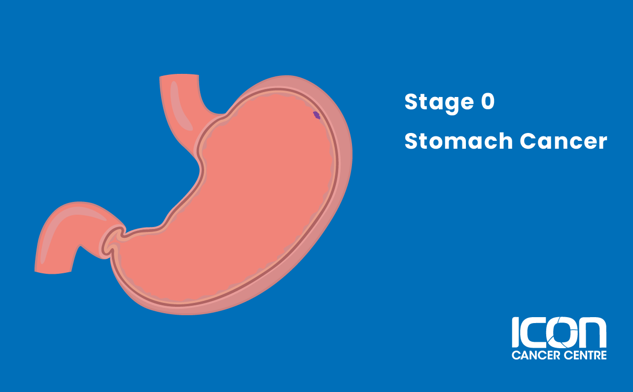 Stage 0 stomach cancer illustration