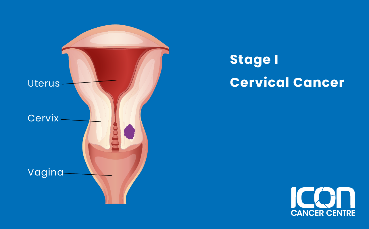 Stage 1 cervical cancer illustration