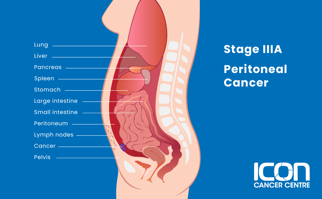 Stage IIIA peritoneal cancer illustration